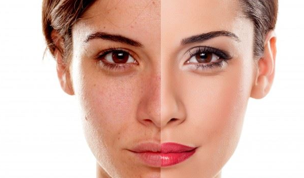 脸上痘印为什么是黑的，脸上有黑色痘印怎么办？